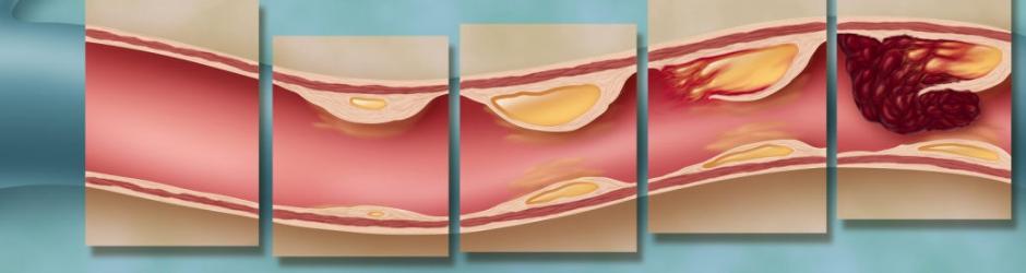 Prevention of atherosclerosis